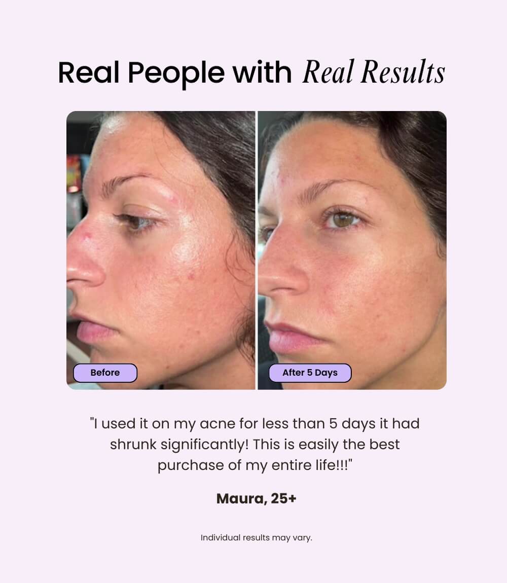 Velve Pro 5-in-1 Skincare Wand Complete Kit - Reskined- Best Price in United States